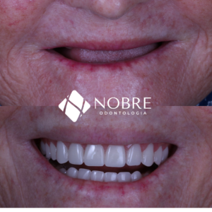 Antes e depois Nobre